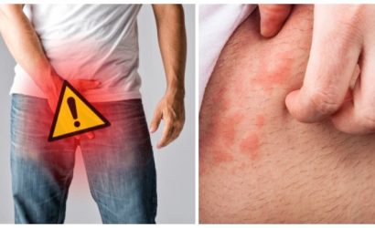 kasık mantarı görselleri , kasık mantarı olduğu nasıl anlaşılır , kasık mantarı en çabuk nasıl geçer , kasık mantarı nasıl temizlenir