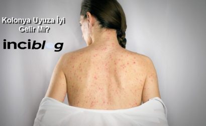 kolonya uyuza iyi gelir mi , sirkeyle uyuzdan kurtulanlar , uyuz olanların yorumları