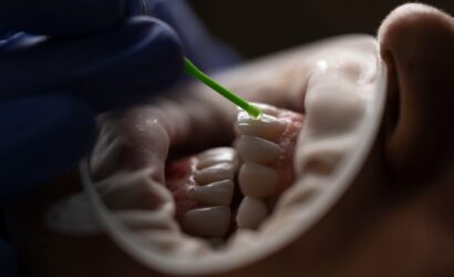 Diş Çekimi Sonrası Kanamanın Neden Durmadığına Dair Bilmeniz Gerekenler